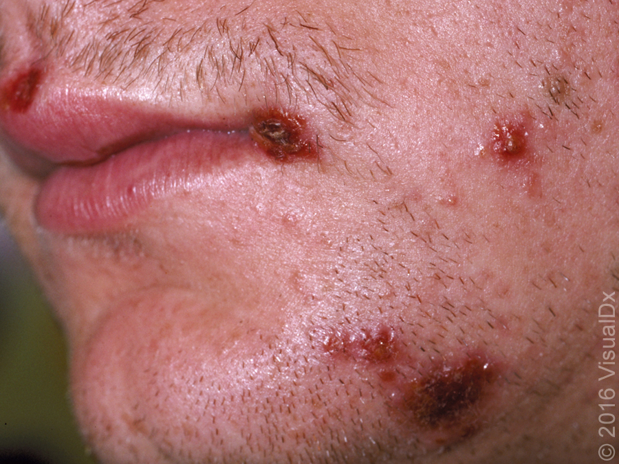 the face with overlying crust (figure); no vesicles or bullous